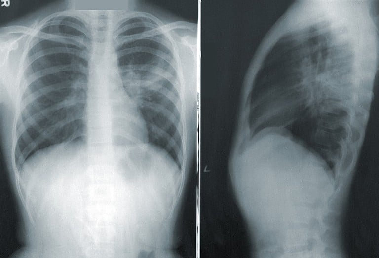 How to Do Percussion Lung Therapy: A Comprehensive Guide