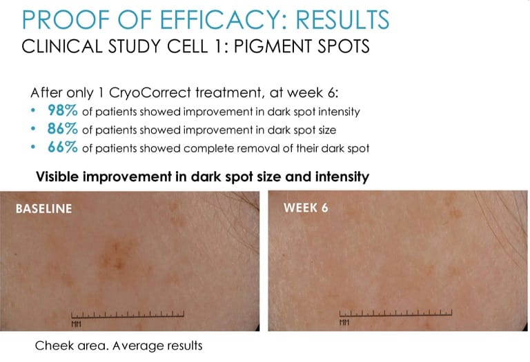 can cryotherapy remove age spots