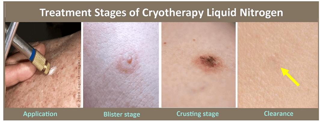 can cryotherapy remove moles