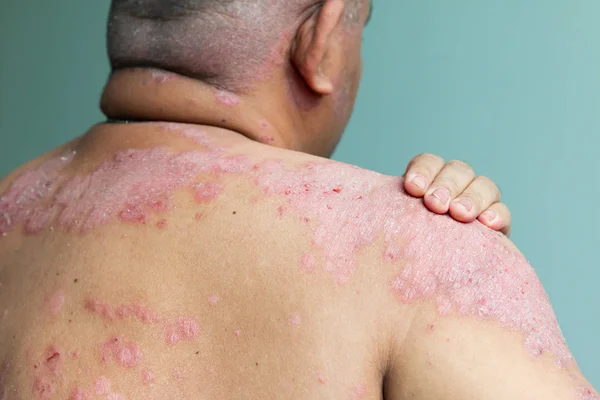 Can Red Light Therapy Help Psoriasis? What You Need to Know