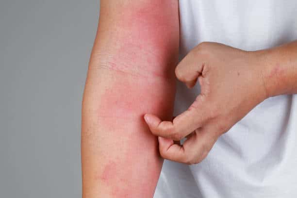 Can Red Light Therapy Cause Itching? Uncover the Facts